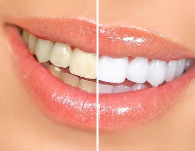 Teeth Whitening vs. Veneers: Which One Is Best?