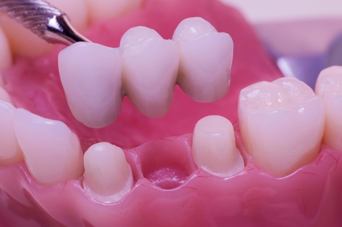 Bridging the Gap: Understanding Dental Bridges in Restorative Dentistry