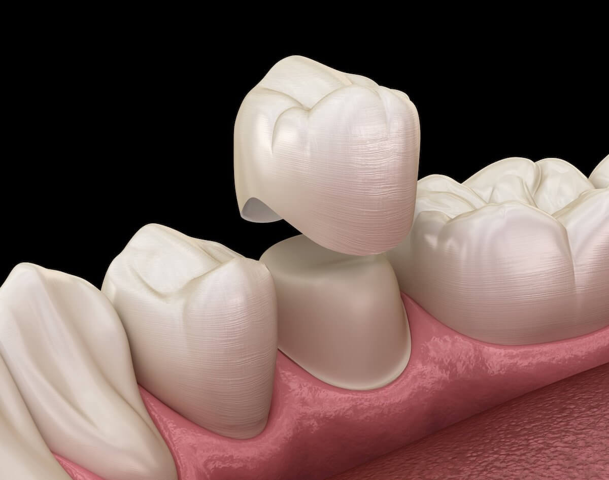 Types of Dental Crowns: Choosing the Right Material for Your Smile