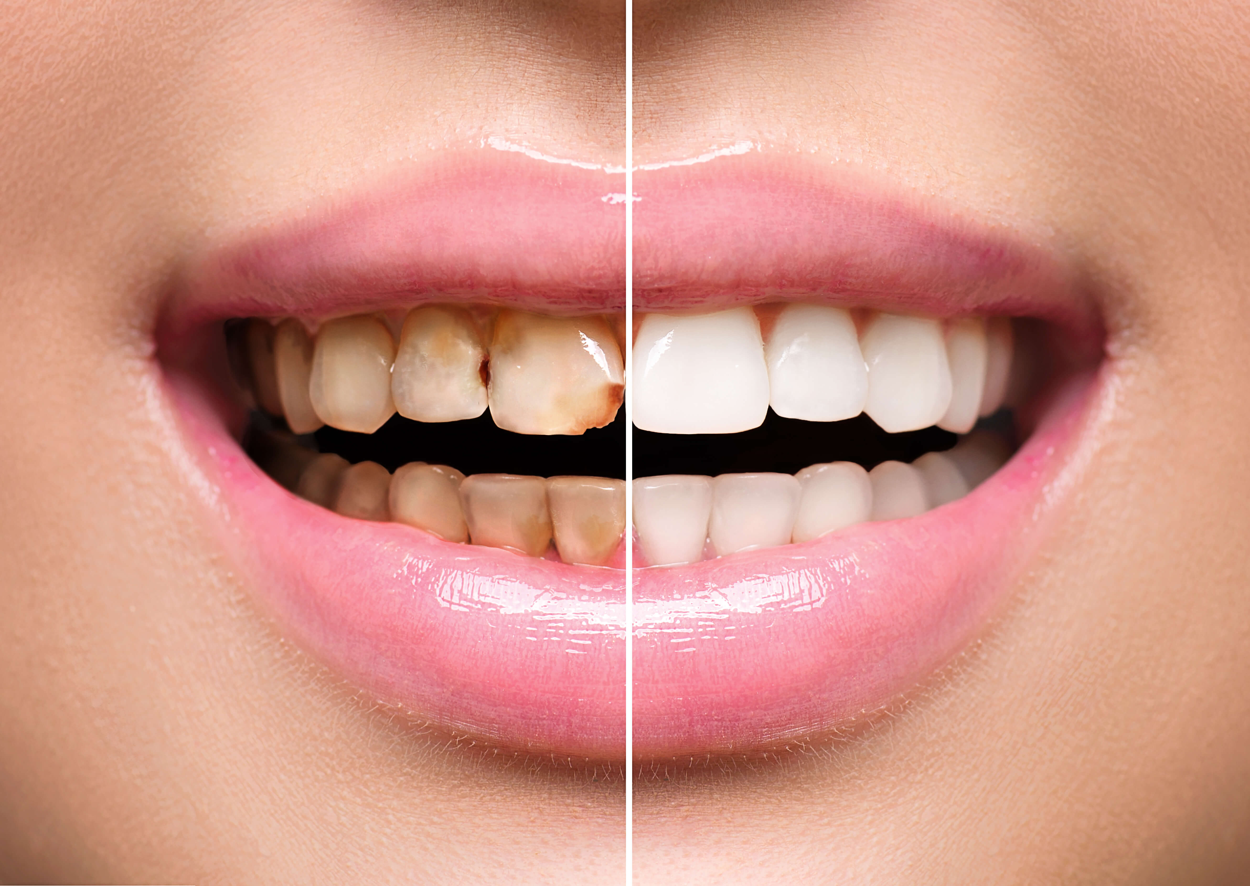 Caring for Restored Smiles: Tips for Long-lasting Dental Work