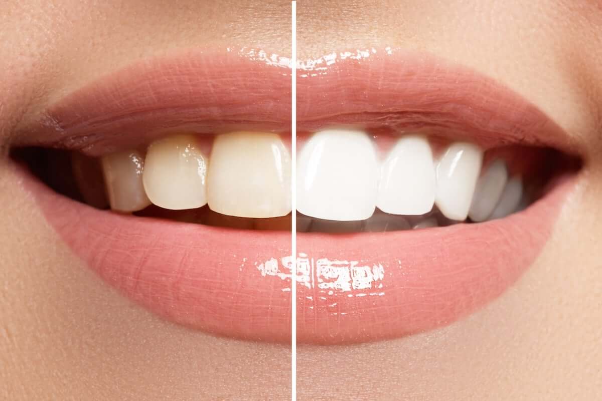 The 3 Best Cosmetic Dental Procedures for a White Smile