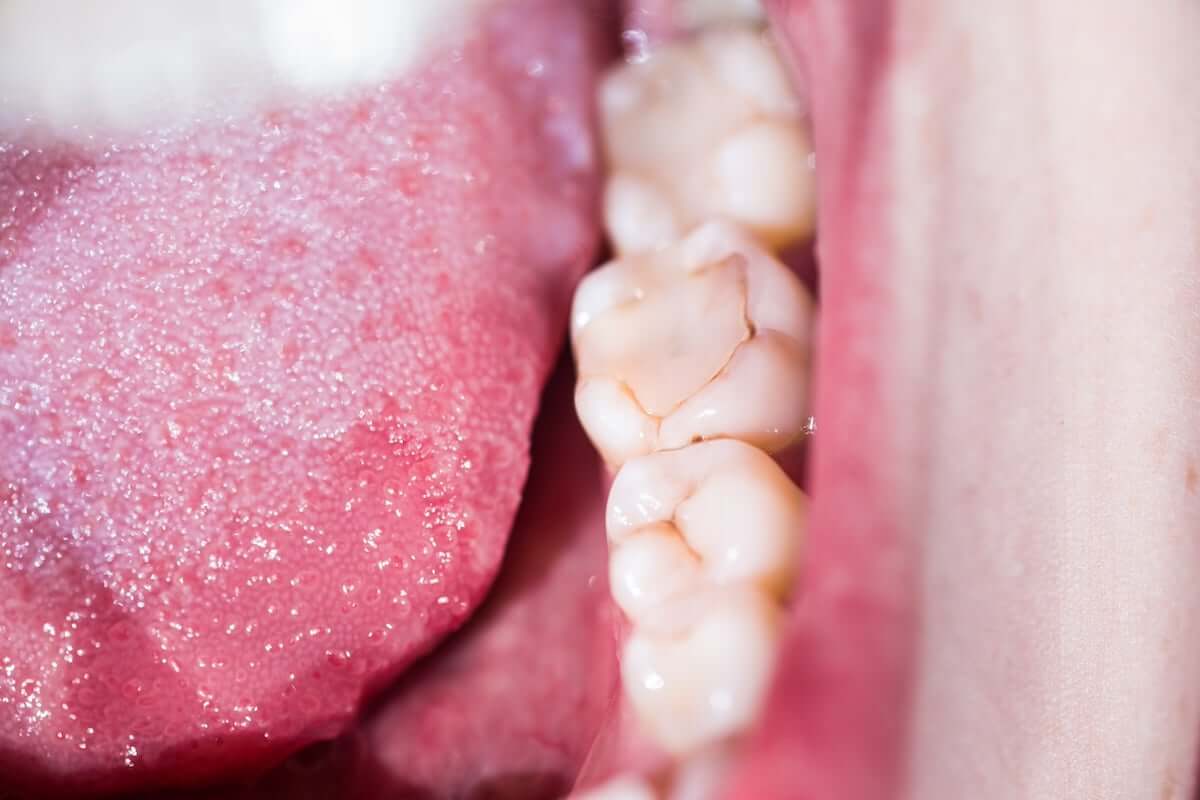 3 Signs that Your Dental Filling Is Going Bad