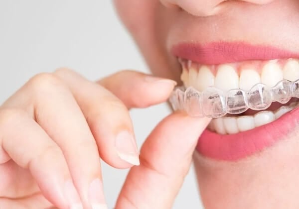 Invisalign1