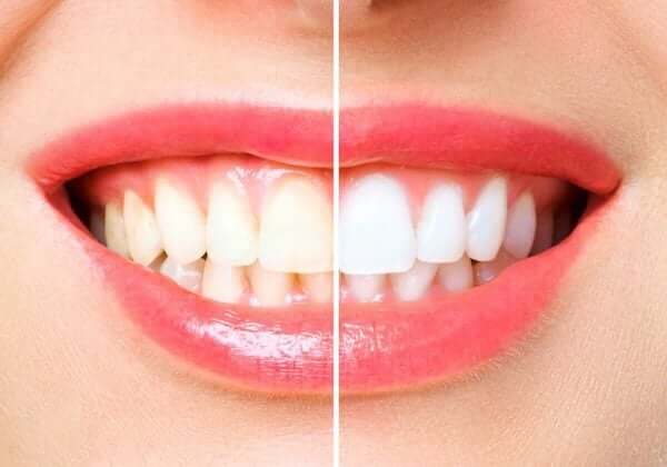 Whitening1