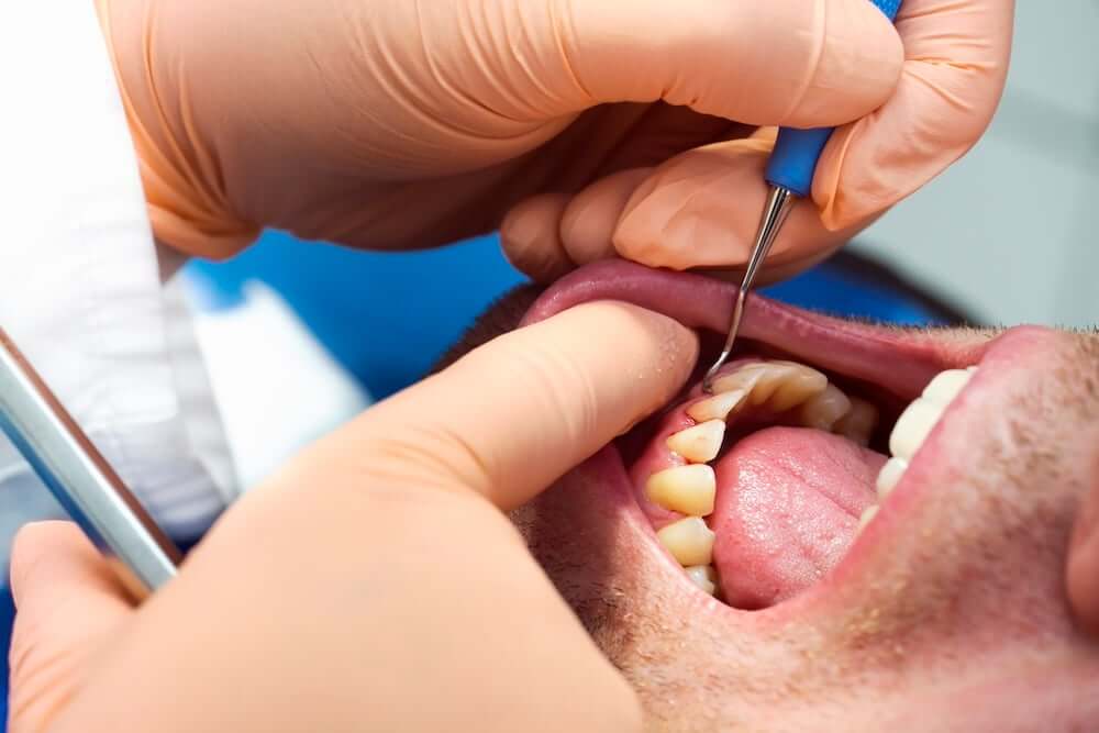 The Stages of Periodontitis: Understanding the Progression