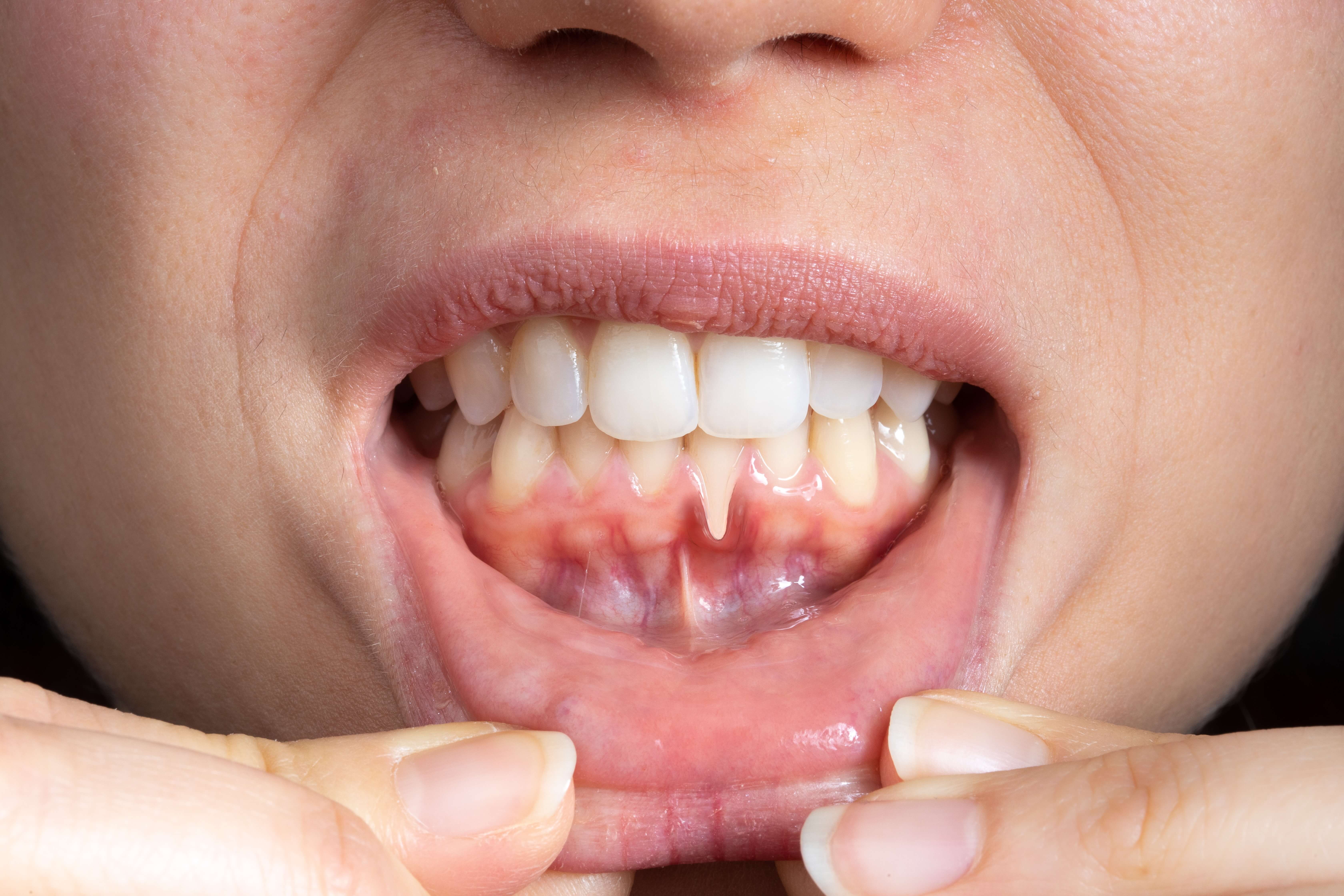 Gum Recession: Causes, Treatment, and Prevention