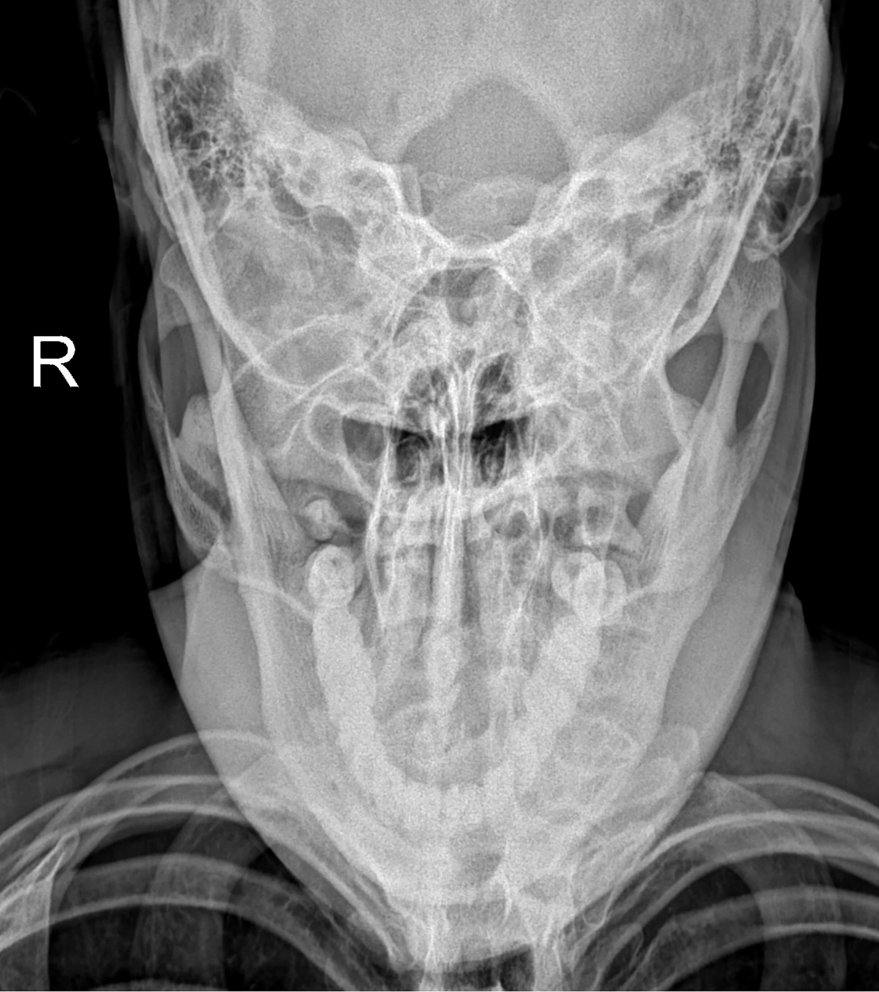 Dens Invaginatus: Exploring the Intricacies of Tooth Development Deformities