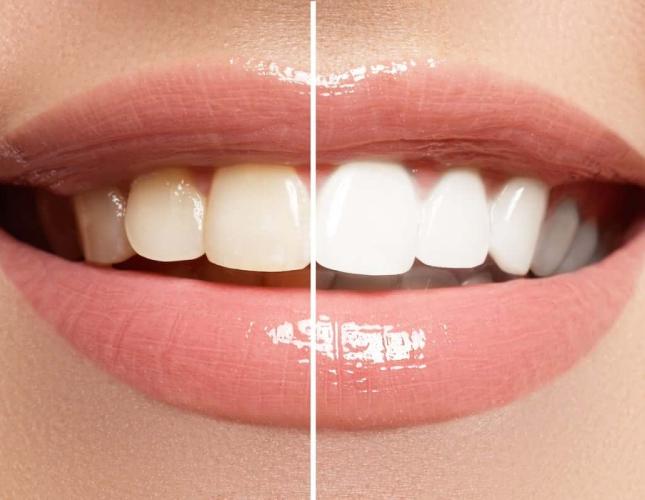 The 3 Best Cosmetic Dental Procedures for a White Smile